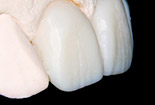 Wax-up