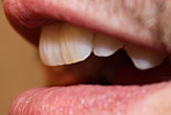 11 Veneer