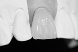 Implantatkrone