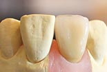 Implantatkrone