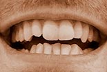 11 Veneer